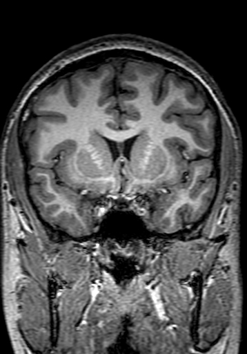 Cerebral arteriovenous malformation at posterior body of corpus callosum (Radiopaedia 74111-84925 Coronal T1 117).jpg