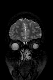 Cerebral arteriovenous malformation at posterior body of corpus callosum (Radiopaedia 74111-84925 Coronal T2 22).jpg