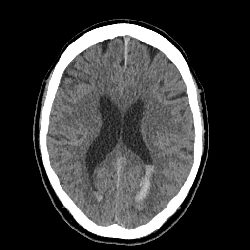 Cerebral arteriovenous malformation with lobar hemorrhage (Radiopaedia 35598-37117 Axial non-contrast 33).jpg