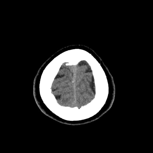 Cerebral arteriovenous malformation with lobar hemorrhage (Radiopaedia 35598-37117 Axial non-contrast 53).jpg