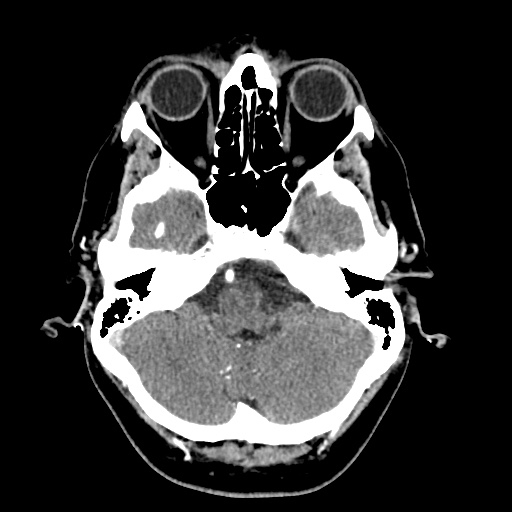 Cerebral arteriovenous malformation with lobar hemorrhage (Radiopaedia 35598-57216 A 13).jpg