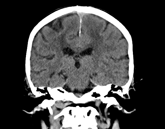 Cerebral arteriovenous malformation with lobar hemorrhage (Radiopaedia 44725-48510 Coronal non-contrast 29).png