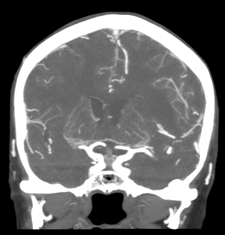 File:Cerebral arteriovenous malformation with lobar hemorrhage (Radiopaedia 44725-48511 B 26).png
