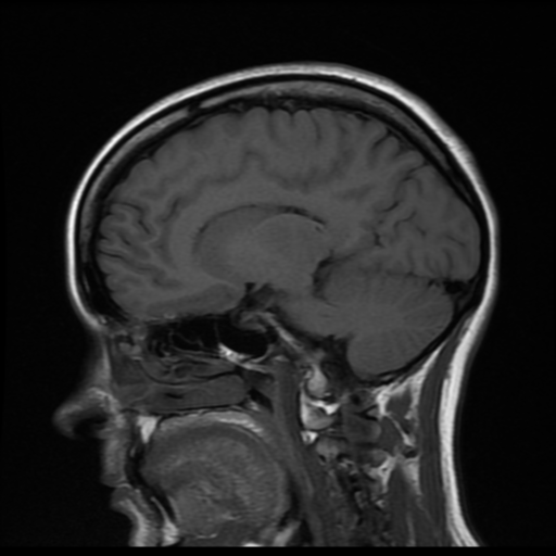 File:Cerebral autosomal dominant arteriopathy with subcortical infarcts and leukoencephalopathy (CADASIL) (Radiopaedia 41018-43768 Sagittal T1 12).png