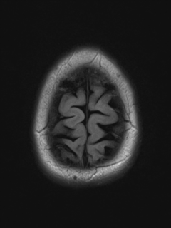 File:Cerebral cavernoma and development venous anomaly (Radiopaedia 37603-39482 Axial FLAIR 21).png