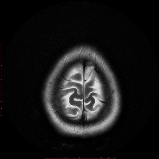 File:Cerebral cavernous malformation (Radiopaedia 26177-26306 Axial T2 20).jpg
