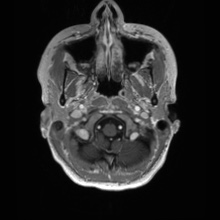Cerebral cavernous venous malformation (Radiopaedia 70008-80021 Axial T1 C+ 3).jpg