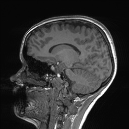File:Cerebral cavernous venous malformation (Radiopaedia 70008-80021 Sagittal T1 44).jpg