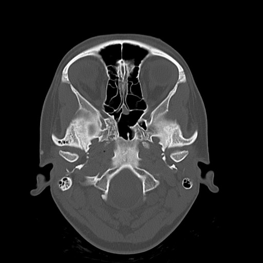 File:Cerebral cavernous venous malformation (Radiopaedia 70008-80022 Axial bone window 3).jpg