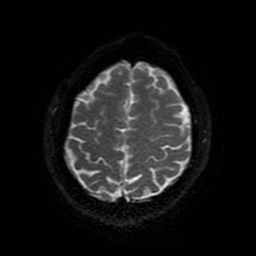 Cerebral cavernous venous malformation (Zabramski type II) (Radiopaedia 85511-101198 Axial DWI 91).jpg