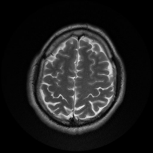 File:Cerebral cavernous venous malformation (Zabramski type II) (Radiopaedia 85511-101198 Axial T2 25).jpg