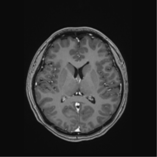 File:Cerebral cavernous venous malformations (Radiopaedia 48117-52946 Axial T1 C+ 33).png