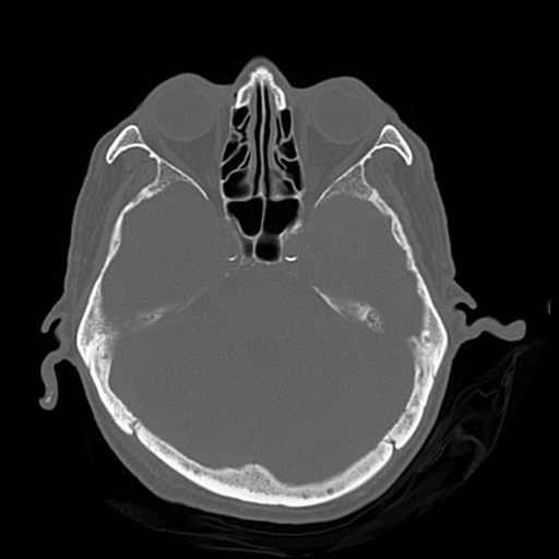Cerebral contusions, subarachnoid hemorrhage and subdural hygromas (Radiopaedia 55399-61827 Axial bone window 17).png