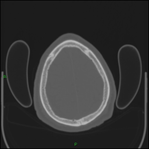 File:Cerebral contusions (Radiopaedia 33868-35039 Axial bone window 189).jpg
