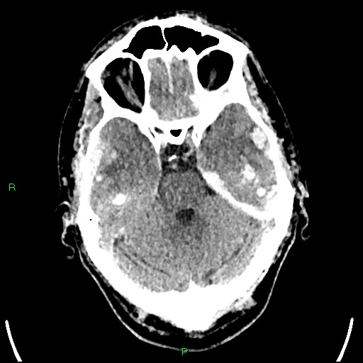 File:Cerebral contusions (Radiopaedia 33868-35039 Axial non-contrast 63).jpg