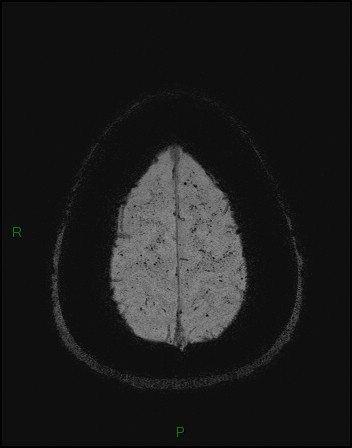 Cerebral fat embolism (Radiopaedia 35022-36525 Axial SWI 58).jpg