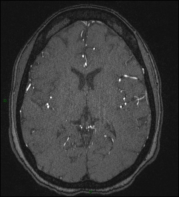 Cerebral fat embolism (Radiopaedia 35022-36525 Axial TOF 115).jpg