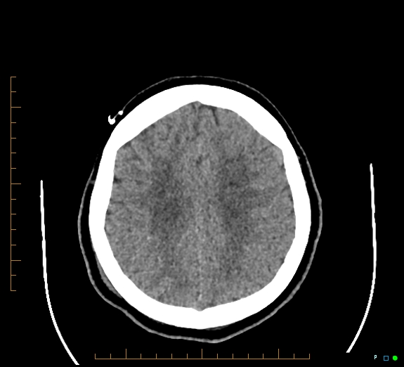 Cerebral fat embolism (Radiopaedia 85521-101220 Axial non-contrast 45).jpg