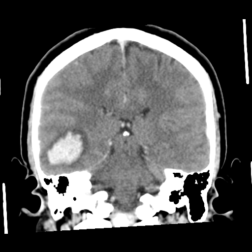 File:Cerebral hemorrhage secondary to arteriovenous malformation (Radiopaedia 33497-34561 C 40).png