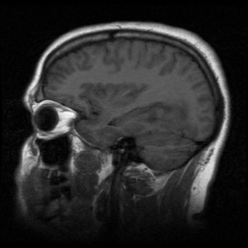 File:Cerebral hemorrhage secondary to arteriovenous malformation (Radiopaedia 33497-34572 Sagittal T1 16).png