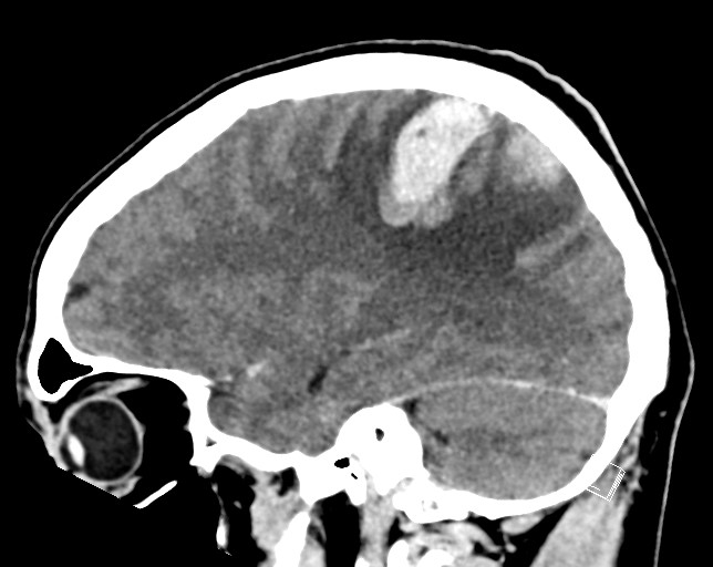 Cerebral metastases - testicular choriocarcinoma (Radiopaedia 84486-99855 F 20).jpg