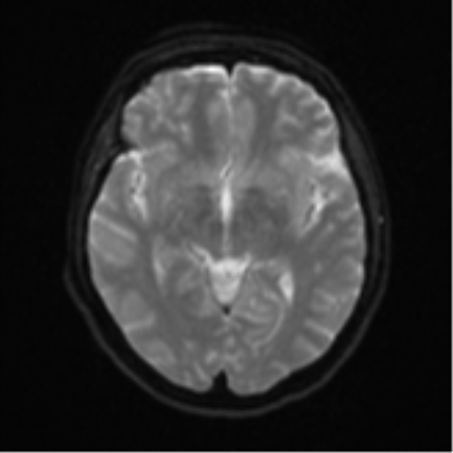 Cerebral metastases mimicking abscesses (Radiopaedia 45841-50131 Axial DWI 14).png