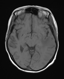 File:Cerebral metastasis (Radiopaedia 46744-51248 Axial T1 12).png