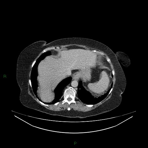 Cerebral metastasis from renal cell carcinoma (Radiopaedia 82306-96378 A 24).jpg