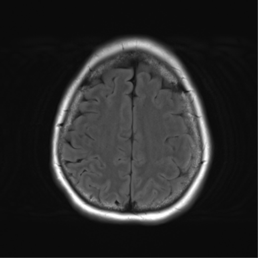 File:Cerebral metastasis mimicking glioblastoma (Radiopaedia 69155-78937 Axial FLAIR 26).png