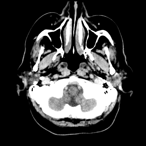 Cerebral metastasis to basal ganglia (Radiopaedia 81568-95412 Axial C+ delayed 10).png