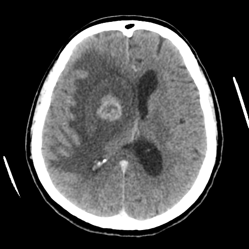 Cerebral metastasis to basal ganglia (Radiopaedia 81568-95412 Axial C+ delayed 34).png