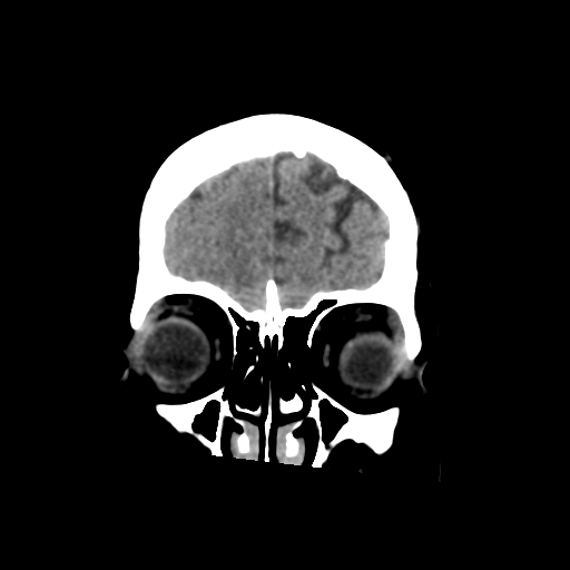Cerebral metastasis to basal ganglia (Radiopaedia 81568-95412 Coronal non-contrast 15).png