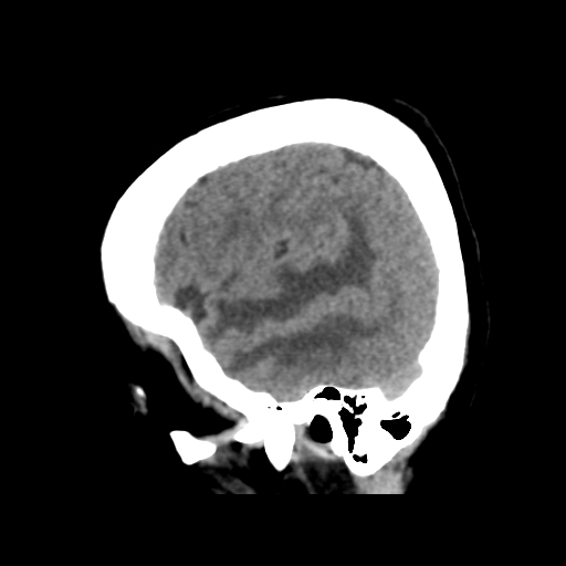Cerebral metastasis to basal ganglia (Radiopaedia 81568-95412 E 14).png