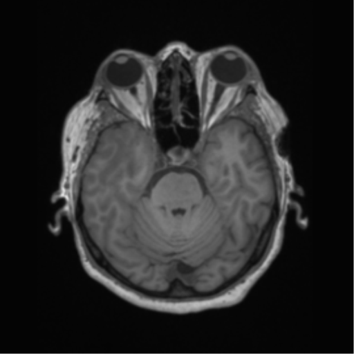 Cerebral metastasis to basal ganglia (Radiopaedia 81568-95413 Axial T1 21).png