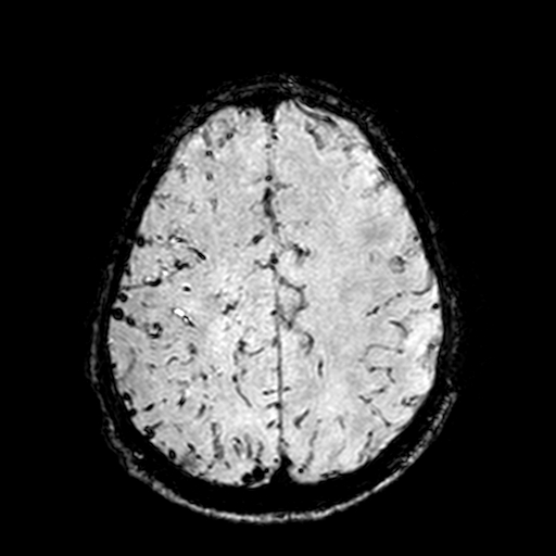 Cerebral parenchymal arteriovenous malformation (Radiopaedia 27280-27456 Axial SWI 90).jpg