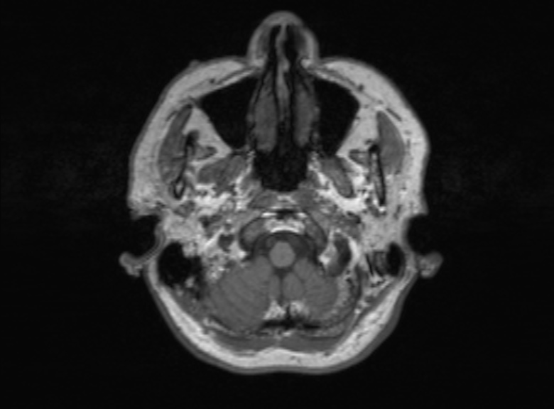 Cerebral ring enhancing lesions - cerebral metastases (Radiopaedia 44922-48817 Axial T1 348).jpg