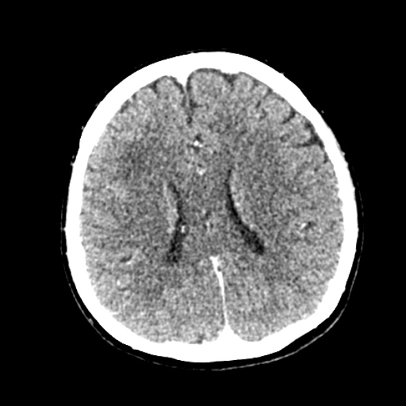 File:Cerebral ring enhancing lesions - cerebral metastases (Radiopaedia 44922-48818 B 179).jpg