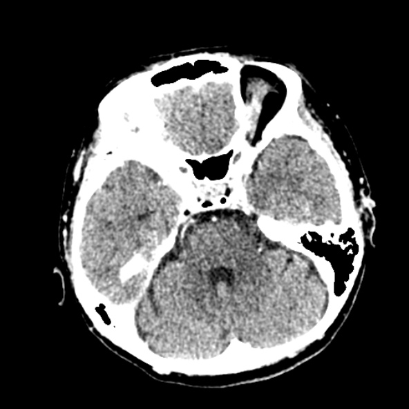 Cerebral ring enhancing lesions - cerebral metastases (Radiopaedia 44922-48818 B 92).jpg
