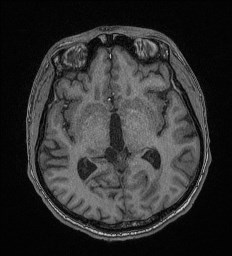 File:Cerebral toxoplasmosis (Radiopaedia 43956-47461 Axial T1 36).jpg