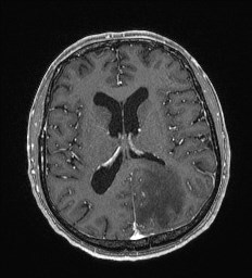 File:Cerebral toxoplasmosis (Radiopaedia 43956-47461 Axial T1 C+ 42).jpg