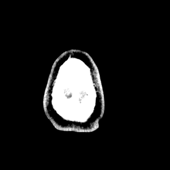 File:Cerebral toxoplasmosis (Radiopaedia 53993-60131 Axial non-contrast 75).jpg
