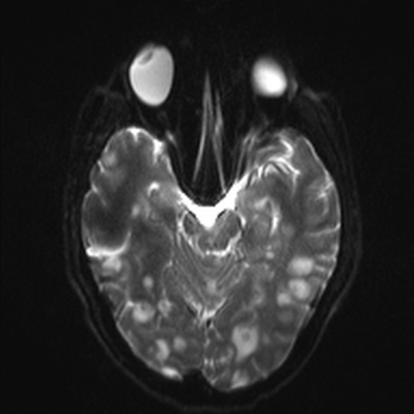 File:Cerebral toxoplasmosis (Radiopaedia 53993-60132 Axial DWI 10).jpg