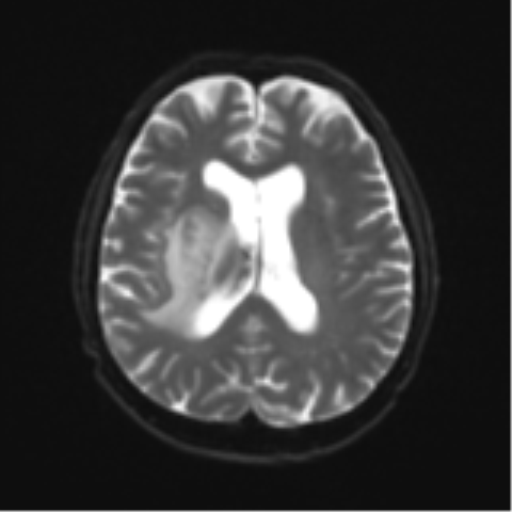 Cerebral toxoplasmosis (Radiopaedia 54575-60804 Axial DWI 20).png