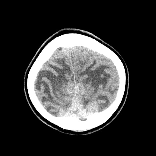 Cerebral tuberculosis with dural sinus invasion (Radiopaedia 60353-68018 Axial non-contrast 54).jpg