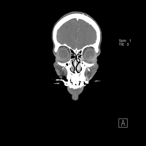 Cerebral venous infarction with hemorrhage (Radiopaedia 65343-74396 B 38).jpg