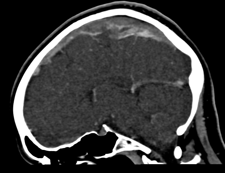 Cerebral venous sinus thrombosis (Radiopaedia 59224-66646 Sagittal C+ delayed 21).jpg