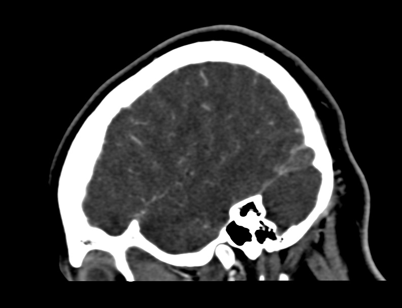 Cerebral venous sinus thrombosis (Radiopaedia 59224-66646 Sagittal C+ delayed 56).jpg