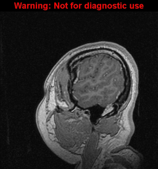 Cerebral venous thrombosis (Radiopaedia 37224-39208 Sagittal T1 C+ 134).jpg