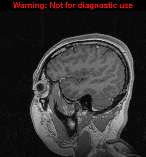 File:Cerebral venous thrombosis (Radiopaedia 37224-39208 Sagittal T1 C+ 33).jpg
