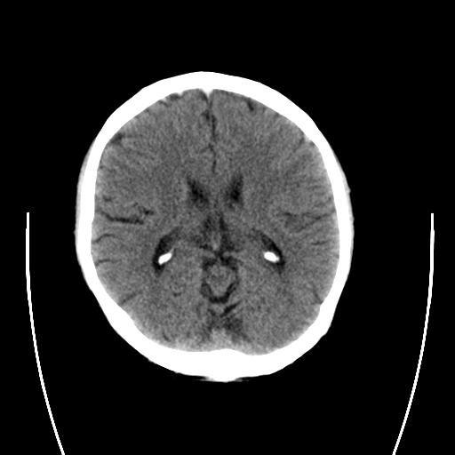 File:Cerebral venous thrombosis (Radiopaedia 38392-40467 C 1).png